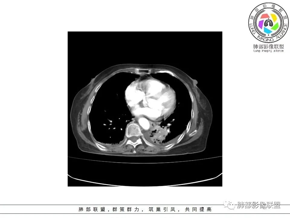 影像PPT - 【病例】最常见的纠结—老年女性,肺部大片实变影-37 影像PPT - 【病例】最常见的纠结—老年女性,肺部大片实变影-37