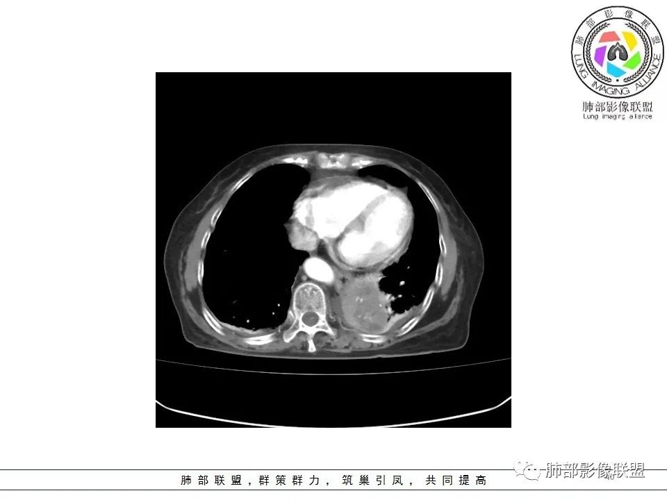 影像PPT - 【病例】最常见的纠结—老年女性,肺部大片实变影-40 影像PPT - 【病例】最常见的纠结—老年女性,肺部大片实变影-40