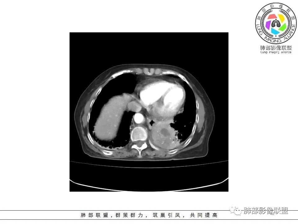 影像PPT - 【病例】最常见的纠结—老年女性,肺部大片实变影-42 影像PPT - 【病例】最常见的纠结—老年女性,肺部大片实变影-42