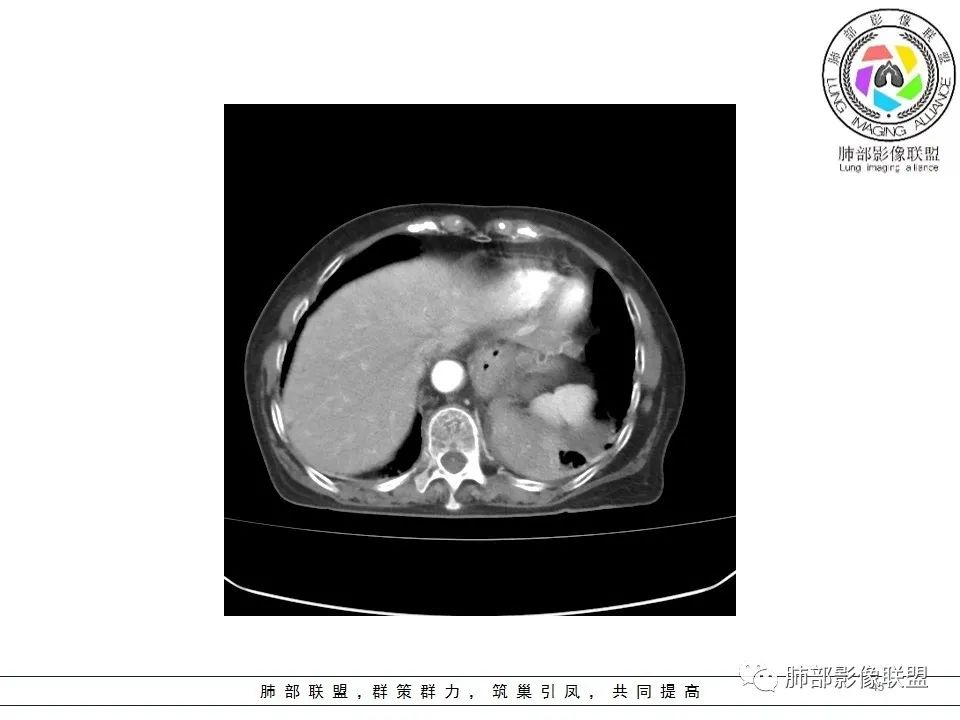 影像PPT - 【病例】最常见的纠结—老年女性,肺部大片实变影-45 影像PPT - 【病例】最常见的纠结—老年女性,肺部大片实变影-45