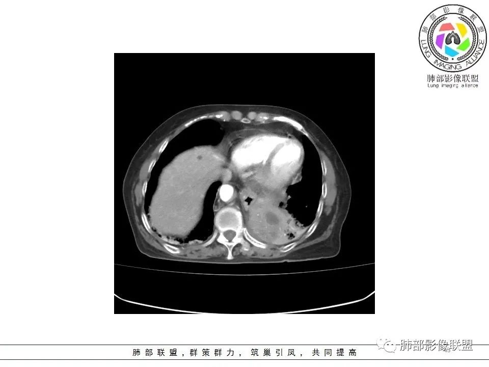 影像PPT - 【病例】最常见的纠结—老年女性,肺部大片实变影-43 影像PPT - 【病例】最常见的纠结—老年女性,肺部大片实变影-43