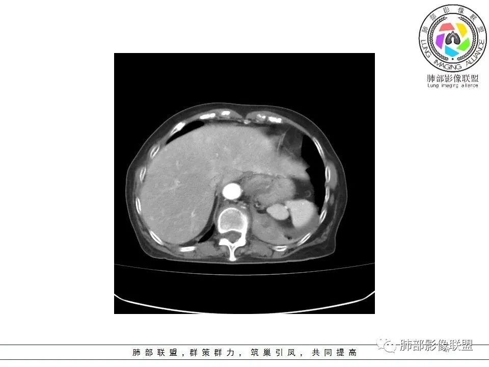 影像PPT - 【病例】最常见的纠结—老年女性,肺部大片实变影-47 影像PPT - 【病例】最常见的纠结—老年女性,肺部大片实变影-47