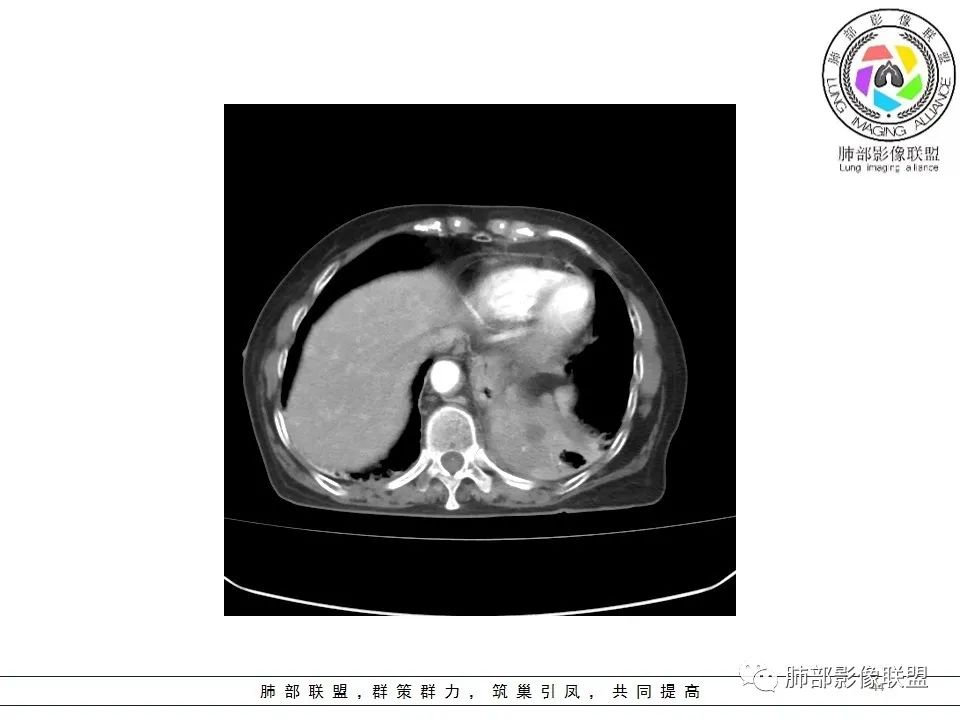 影像PPT - 【病例】最常见的纠结—老年女性,肺部大片实变影-44 影像PPT - 【病例】最常见的纠结—老年女性,肺部大片实变影-44