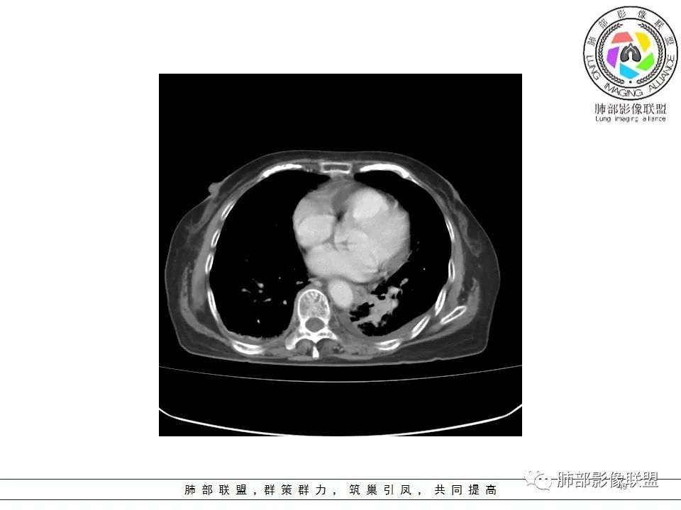 影像PPT - 【病例】最常见的纠结—老年女性,肺部大片实变影-49 影像PPT - 【病例】最常见的纠结—老年女性,肺部大片实变影-49