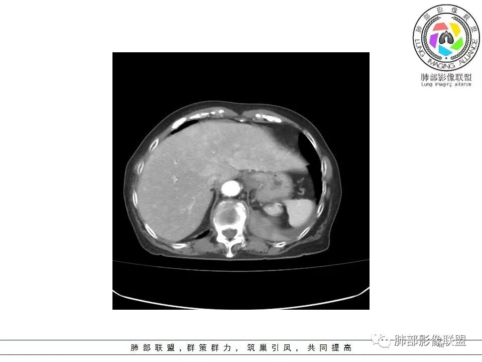 影像PPT - 【病例】最常见的纠结—老年女性,肺部大片实变影-48 影像PPT - 【病例】最常见的纠结—老年女性,肺部大片实变影-48