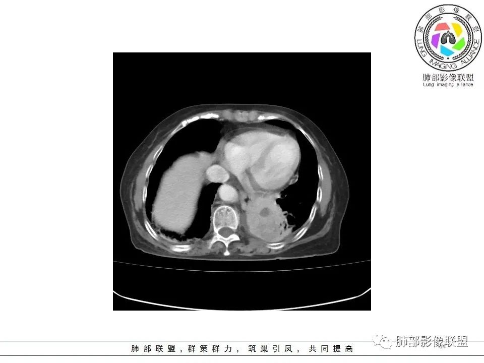 影像PPT - 【病例】最常见的纠结—老年女性,肺部大片实变影-54 影像PPT - 【病例】最常见的纠结—老年女性,肺部大片实变影-54