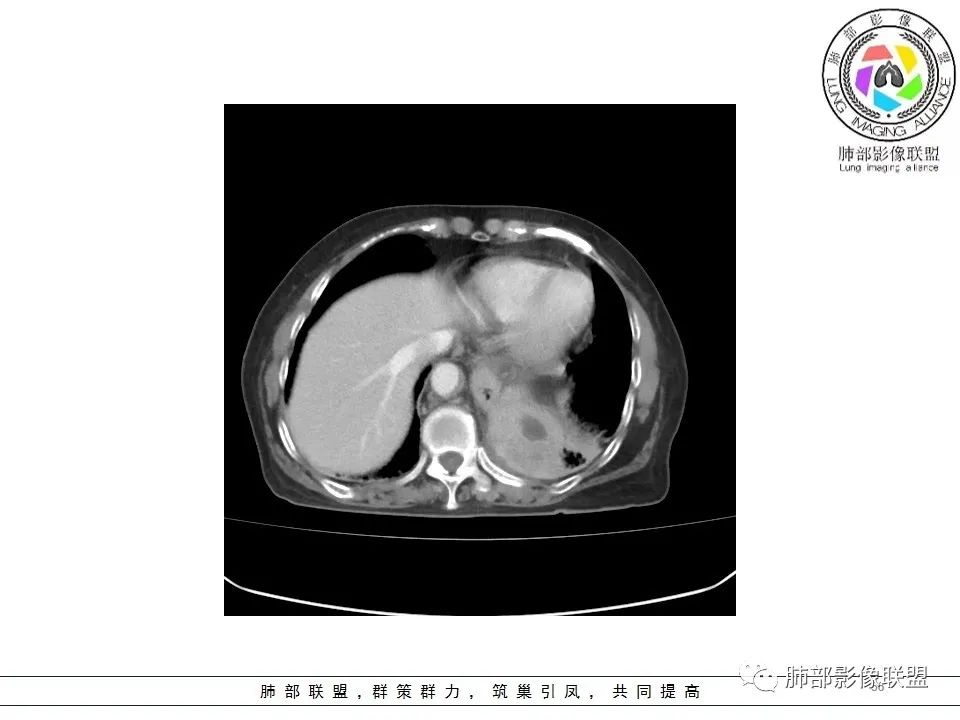 影像PPT - 【病例】最常见的纠结—老年女性,肺部大片实变影-56 影像PPT - 【病例】最常见的纠结—老年女性,肺部大片实变影-56