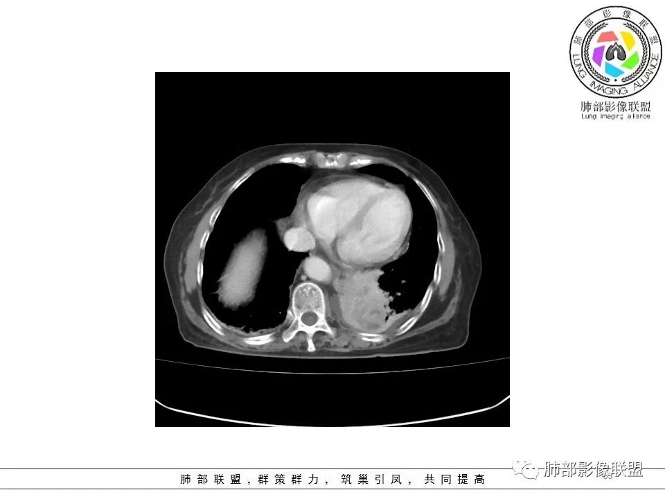 影像PPT - 【病例】最常见的纠结—老年女性,肺部大片实变影-53 影像PPT - 【病例】最常见的纠结—老年女性,肺部大片实变影-53
