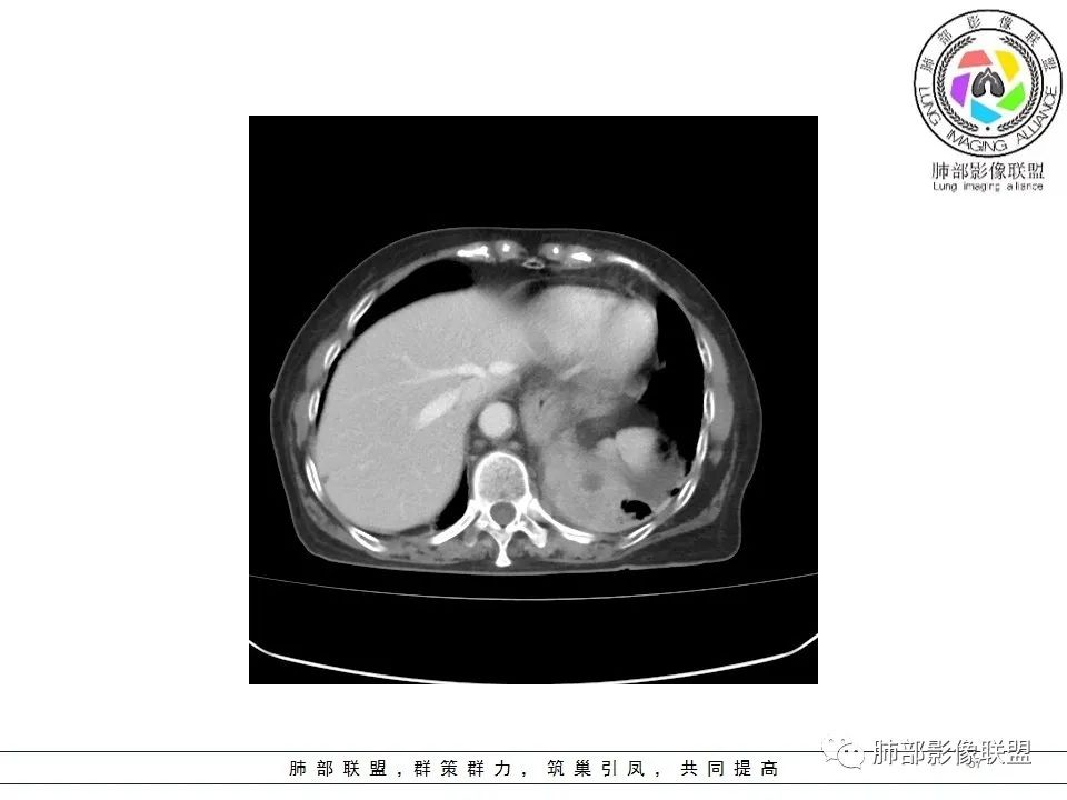 影像PPT - 【病例】最常见的纠结—老年女性,肺部大片实变影-57 影像PPT - 【病例】最常见的纠结—老年女性,肺部大片实变影-57