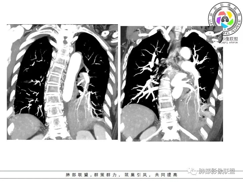 影像PPT - 【病例】最常见的纠结—老年女性,肺部大片实变影-60 影像PPT - 【病例】最常见的纠结—老年女性,肺部大片实变影-60