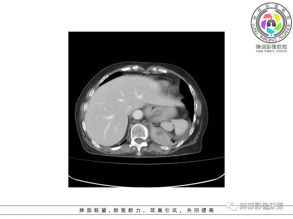 影像PPT - 【病例】最常见的纠结—老年女性,肺部大片实变影-59 影像PPT - 【病例】最常见的纠结—老年女性,肺部大片实变影-59