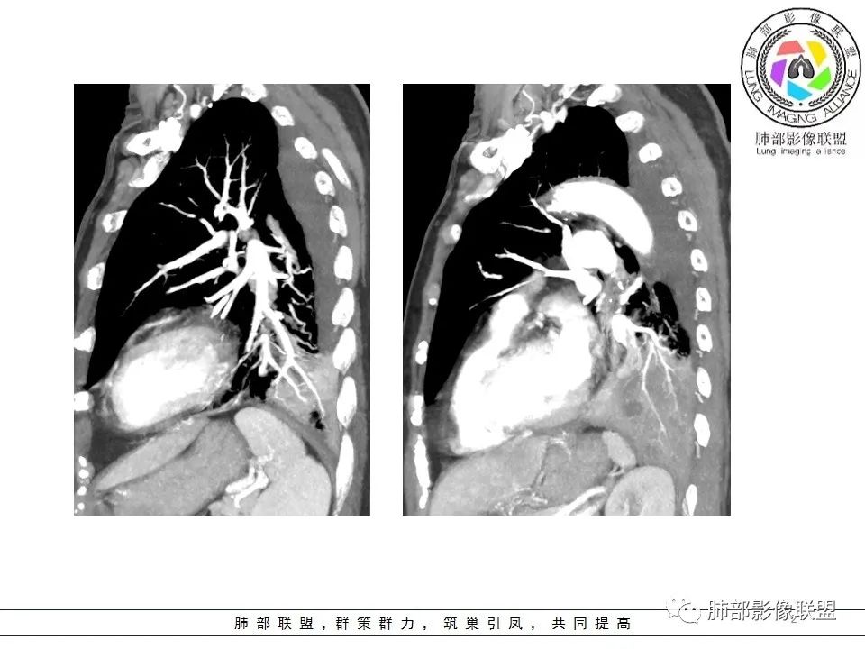 影像PPT - 【病例】最常见的纠结—老年女性,肺部大片实变影-61 影像PPT - 【病例】最常见的纠结—老年女性,肺部大片实变影-61
