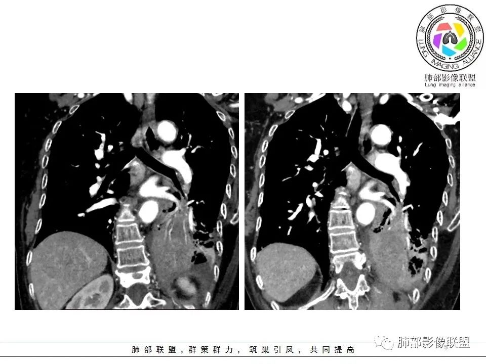 影像PPT - 【病例】最常见的纠结—老年女性,肺部大片实变影-62 影像PPT - 【病例】最常见的纠结—老年女性,肺部大片实变影-62