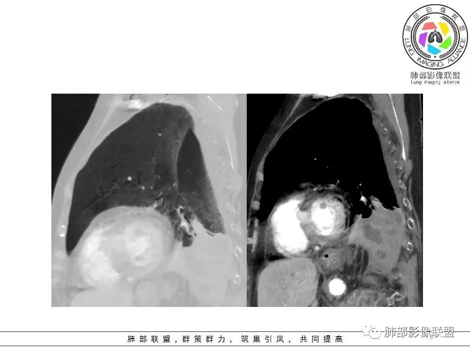 影像PPT - 【病例】最常见的纠结—老年女性,肺部大片实变影-64 影像PPT - 【病例】最常见的纠结—老年女性,肺部大片实变影-64