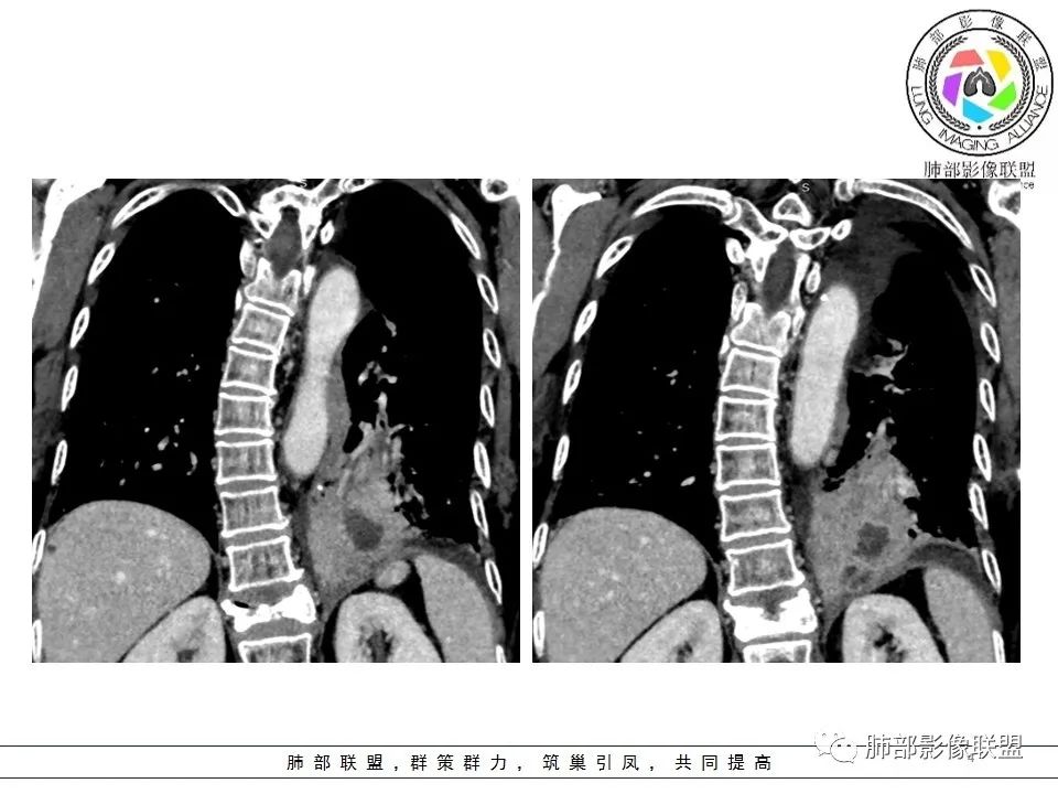 影像PPT - 【病例】最常见的纠结—老年女性,肺部大片实变影-63 影像PPT - 【病例】最常见的纠结—老年女性,肺部大片实变影-63