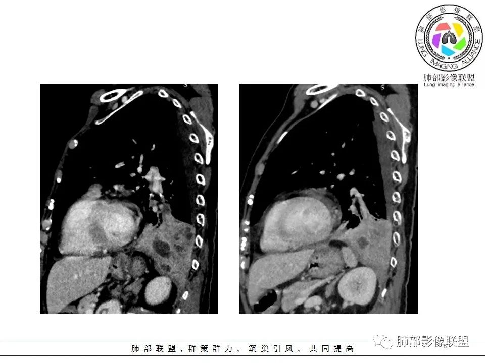 影像PPT - 【病例】最常见的纠结—老年女性,肺部大片实变影-65 影像PPT - 【病例】最常见的纠结—老年女性,肺部大片实变影-65