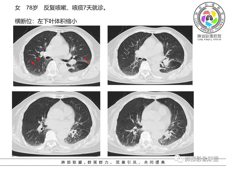 影像PPT - 【病例】最常见的纠结—老年女性,肺部大片实变影-67 影像PPT - 【病例】最常见的纠结—老年女性,肺部大片实变影-67