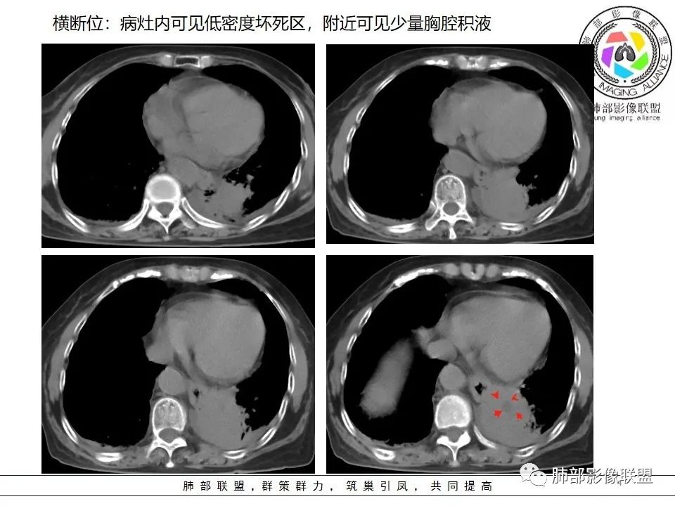 影像PPT - 【病例】最常见的纠结—老年女性,肺部大片实变影-70 影像PPT - 【病例】最常见的纠结—老年女性,肺部大片实变影-70