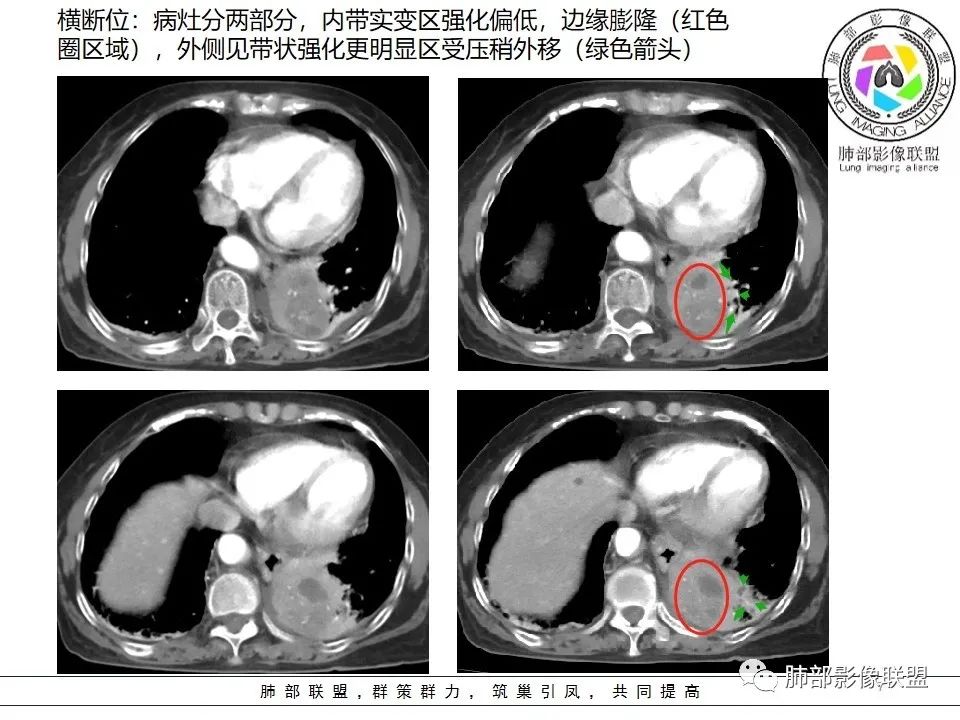 影像PPT - 【病例】最常见的纠结—老年女性,肺部大片实变影-73 影像PPT - 【病例】最常见的纠结—老年女性,肺部大片实变影-73