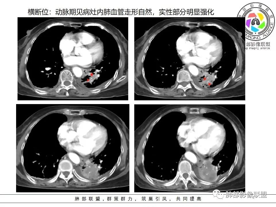 影像PPT - 【病例】最常见的纠结—老年女性,肺部大片实变影-72 影像PPT - 【病例】最常见的纠结—老年女性,肺部大片实变影-72