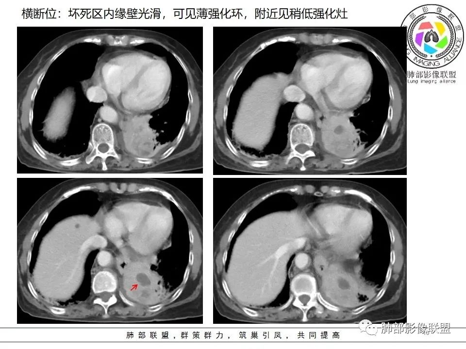 影像PPT - 【病例】最常见的纠结—老年女性,肺部大片实变影-76 影像PPT - 【病例】最常见的纠结—老年女性,肺部大片实变影-76