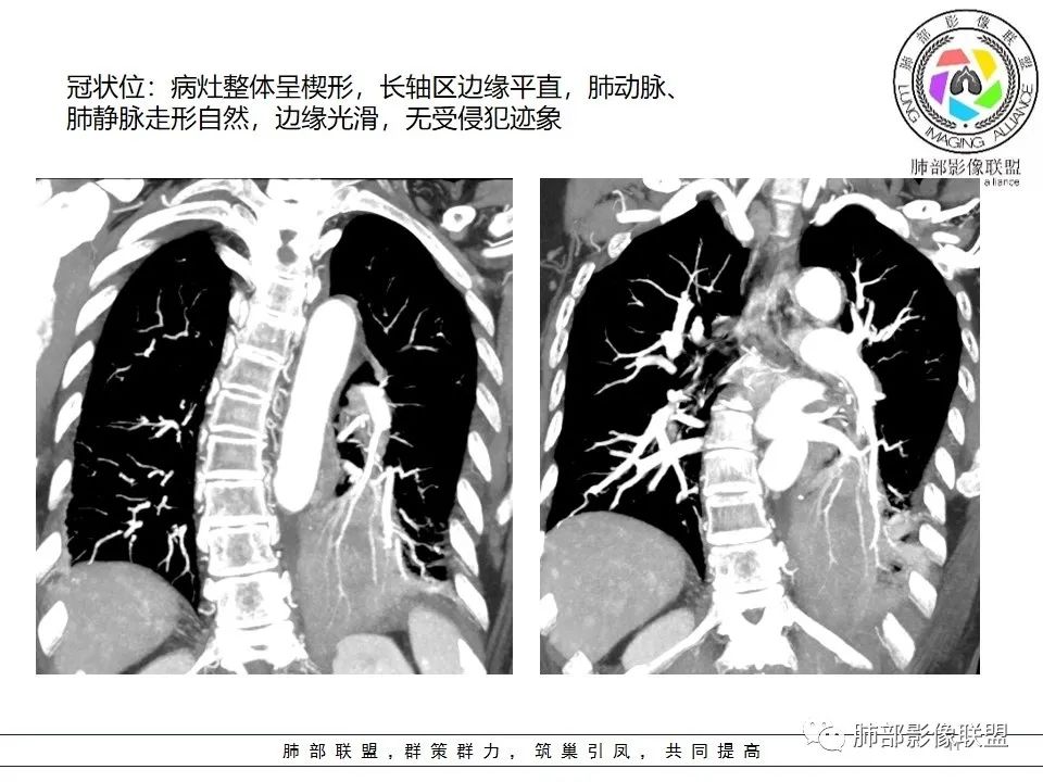 影像PPT - 【病例】最常见的纠结—老年女性,肺部大片实变影-77 影像PPT - 【病例】最常见的纠结—老年女性,肺部大片实变影-77