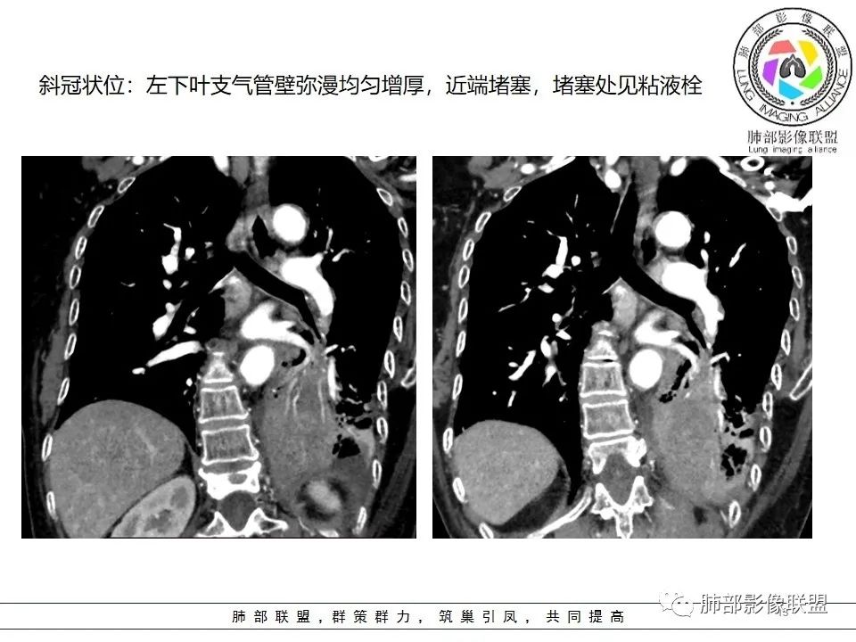 影像PPT - 【病例】最常见的纠结—老年女性,肺部大片实变影-79 影像PPT - 【病例】最常见的纠结—老年女性,肺部大片实变影-79