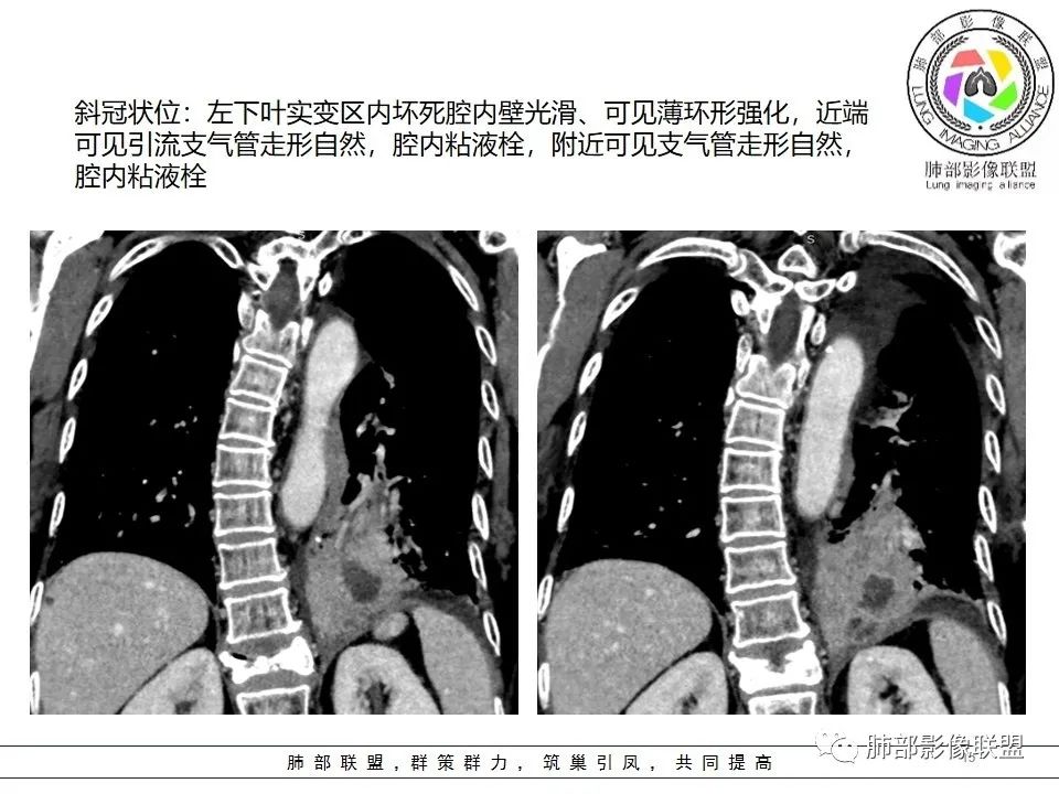 影像PPT - 【病例】最常见的纠结—老年女性,肺部大片实变影-81 影像PPT - 【病例】最常见的纠结—老年女性,肺部大片实变影-81
