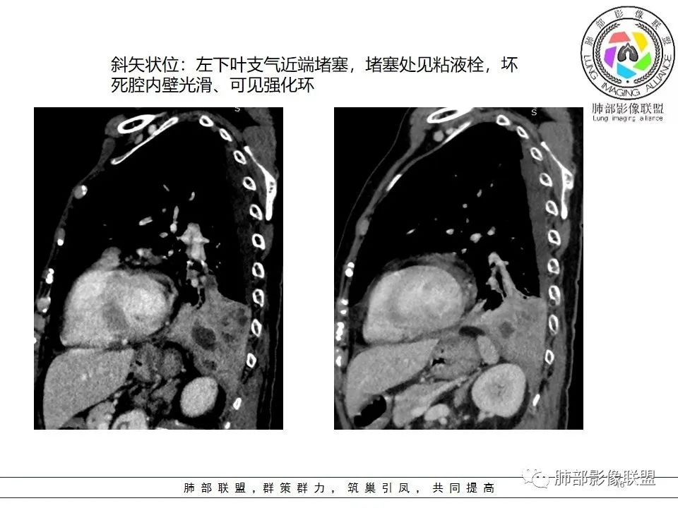 影像PPT - 【病例】最常见的纠结—老年女性,肺部大片实变影-82 影像PPT - 【病例】最常见的纠结—老年女性,肺部大片实变影-82