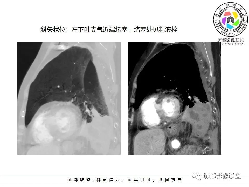 影像PPT - 【病例】最常见的纠结—老年女性,肺部大片实变影-80 影像PPT - 【病例】最常见的纠结—老年女性,肺部大片实变影-80
