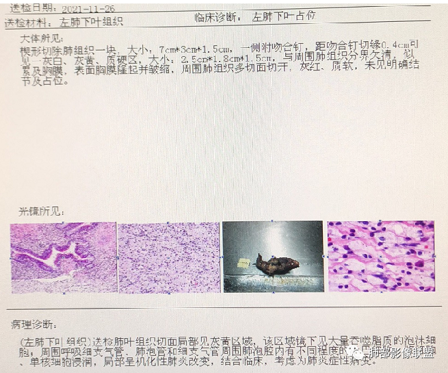 影像PPT - 【病例】最常见的纠结—老年女性,肺部大片实变影-83 影像PPT - 【病例】最常见的纠结—老年女性,肺部大片实变影-83