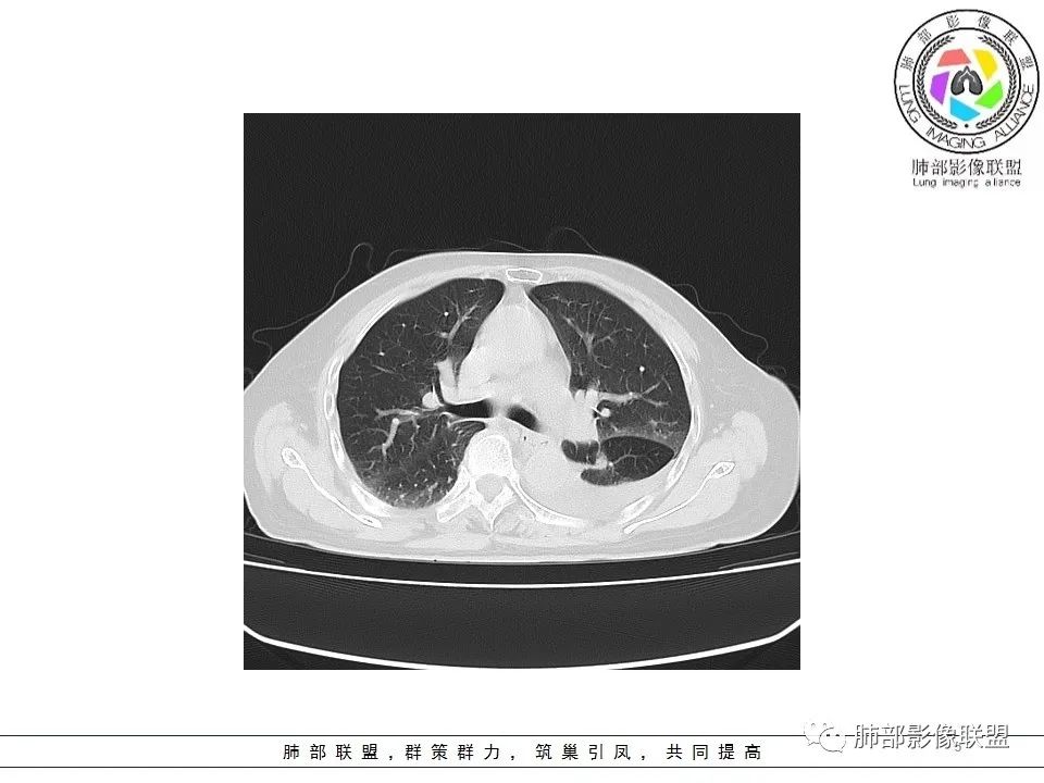 影像PPT - 【病例】最常见的纠结—老年女性,肺部大片实变影-1 影像PPT - 【病例】最常见的纠结—老年女性,肺部大片实变影-1