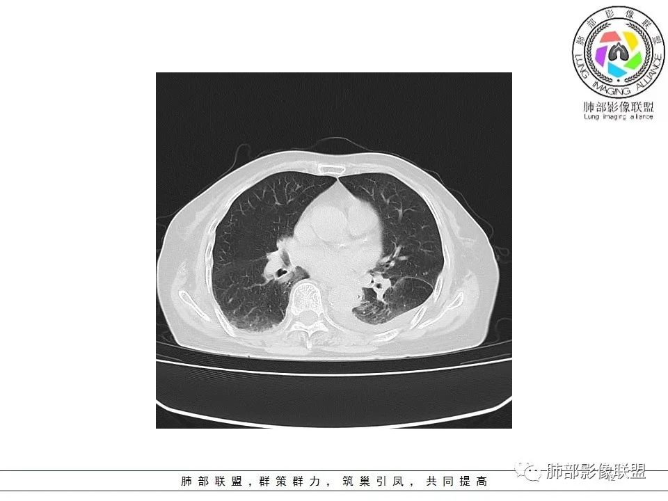 影像PPT - 【病例】最常见的纠结—老年女性,肺部大片实变影-3 影像PPT - 【病例】最常见的纠结—老年女性,肺部大片实变影-3