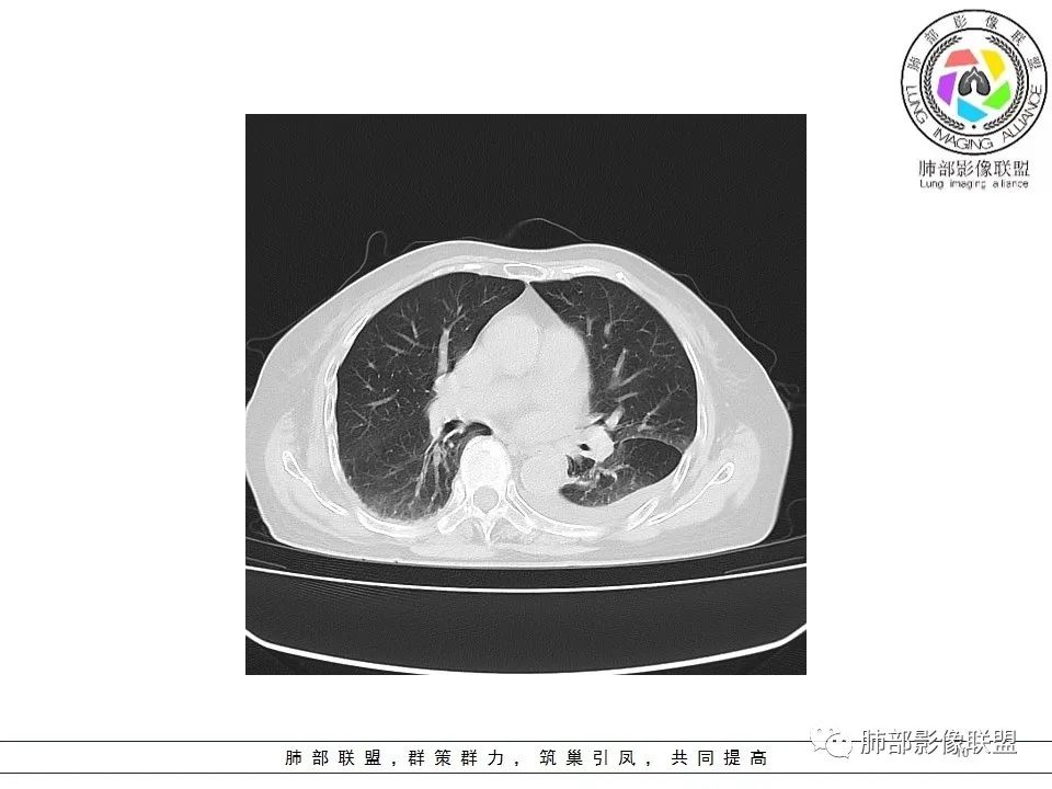 影像PPT - 【病例】最常见的纠结—老年女性,肺部大片实变影-2 影像PPT - 【病例】最常见的纠结—老年女性,肺部大片实变影-2