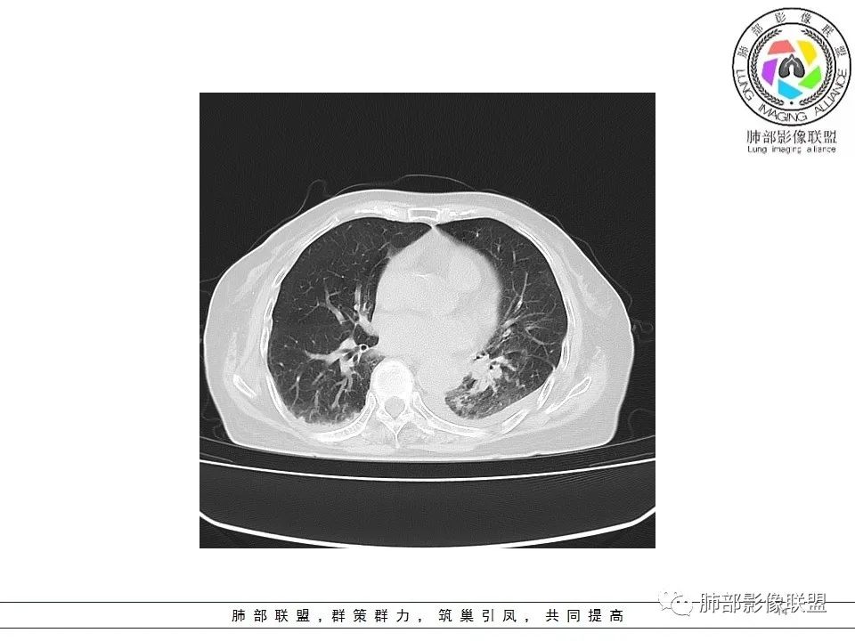影像PPT - 【病例】最常见的纠结—老年女性,肺部大片实变影-4 影像PPT - 【病例】最常见的纠结—老年女性,肺部大片实变影-4