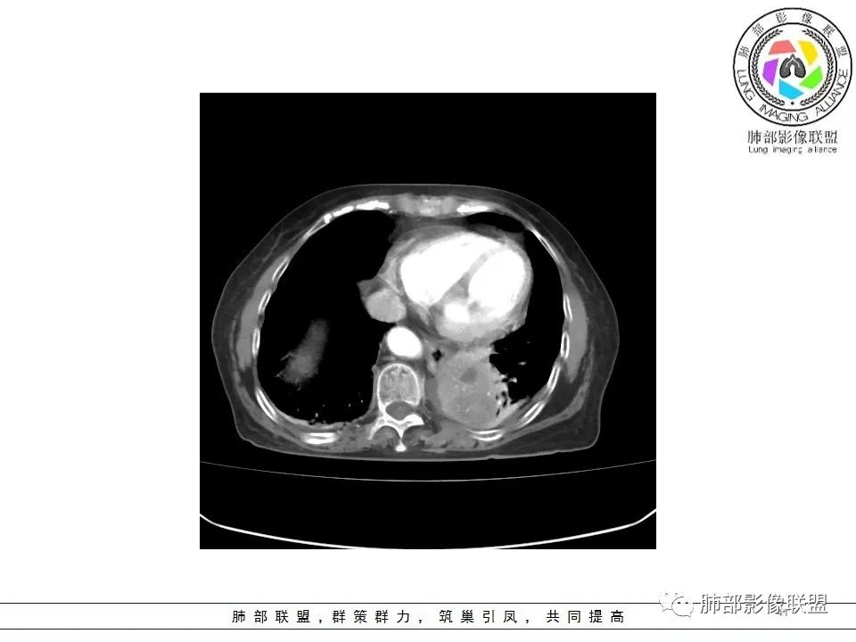 影像PPT - 【病例】最常见的纠结—老年女性,肺部大片实变影-6 影像PPT - 【病例】最常见的纠结—老年女性,肺部大片实变影-6