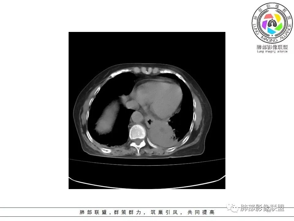 影像PPT - 【病例】最常见的纠结—老年女性,肺部大片实变影-5 影像PPT - 【病例】最常见的纠结—老年女性,肺部大片实变影-5