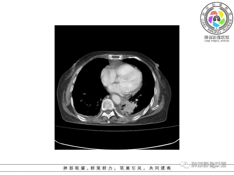 影像PPT - 【病例】最常见的纠结—老年女性,肺部大片实变影-7 影像PPT - 【病例】最常见的纠结—老年女性,肺部大片实变影-7