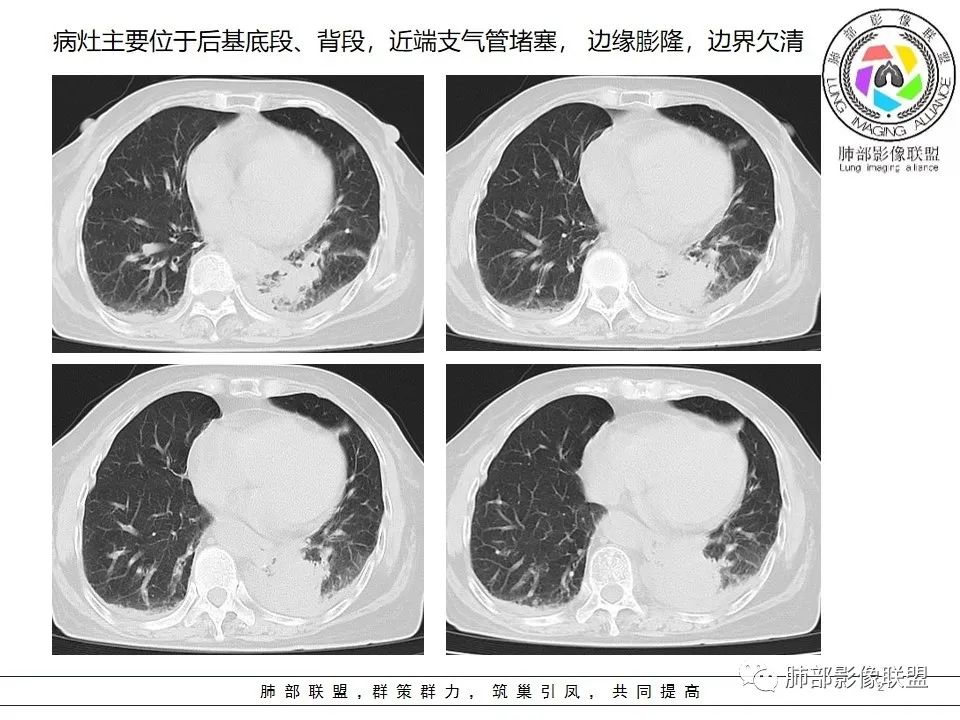 影像PPT - 【病例】最常见的纠结—老年女性,肺部大片实变影-11 影像PPT - 【病例】最常见的纠结—老年女性,肺部大片实变影-11