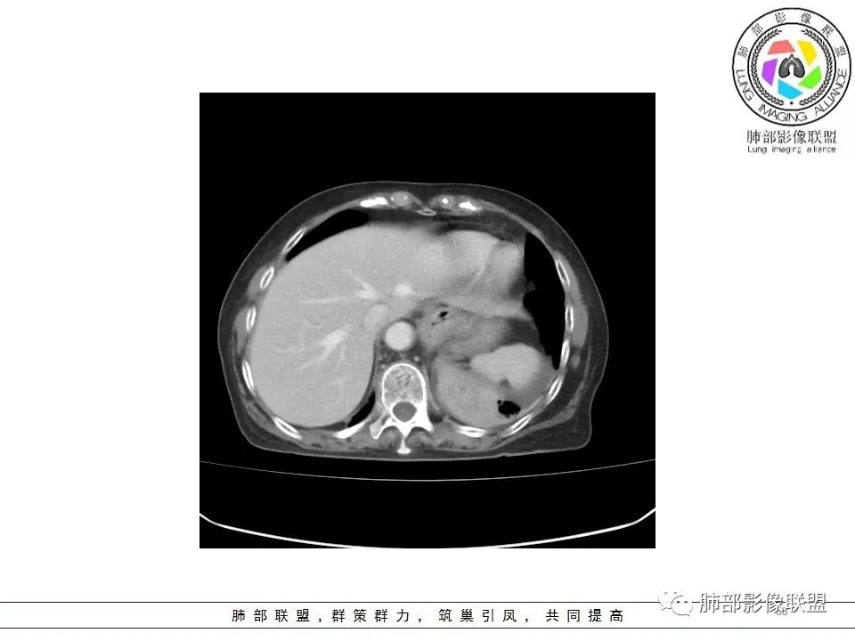 影像PPT - 【病例】最常见的纠结—老年女性,肺部大片实变影-10 影像PPT - 【病例】最常见的纠结—老年女性,肺部大片实变影-10