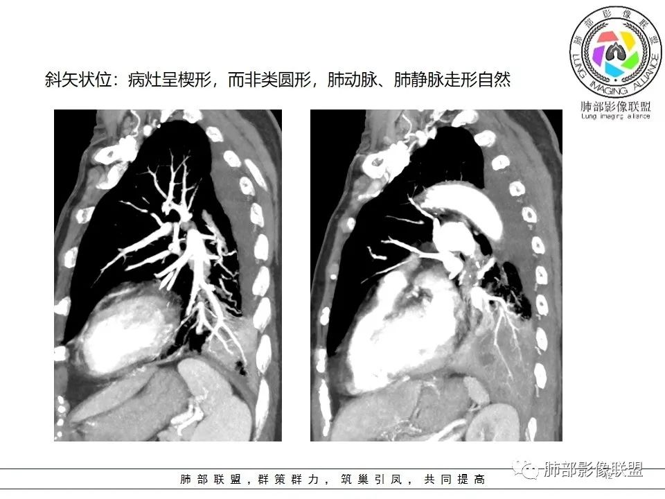 影像PPT - 【病例】最常见的纠结—老年女性,肺部大片实变影-13 影像PPT - 【病例】最常见的纠结—老年女性,肺部大片实变影-13