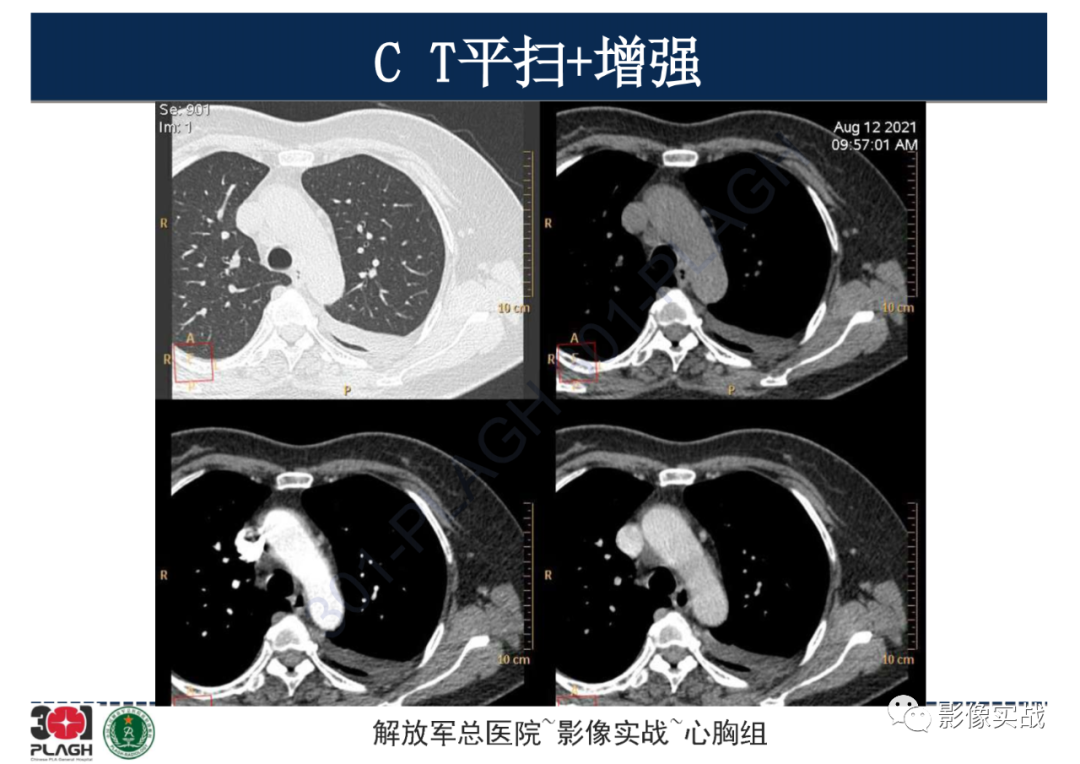 影像PPT - 【病例】左侧胸腔孤立性纤维肿瘤1例CT-3