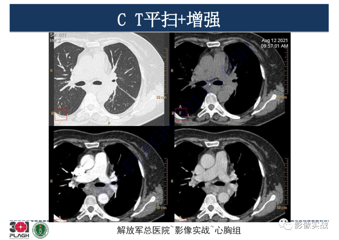 影像PPT - 【病例】左侧胸腔孤立性纤维肿瘤1例CT-4