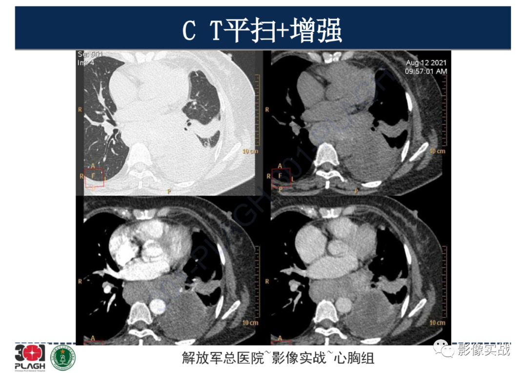 影像PPT - 【病例】左侧胸腔孤立性纤维肿瘤1例CT-6