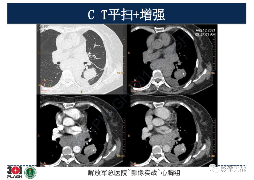 影像PPT - 【病例】左侧胸腔孤立性纤维肿瘤1例CT-5