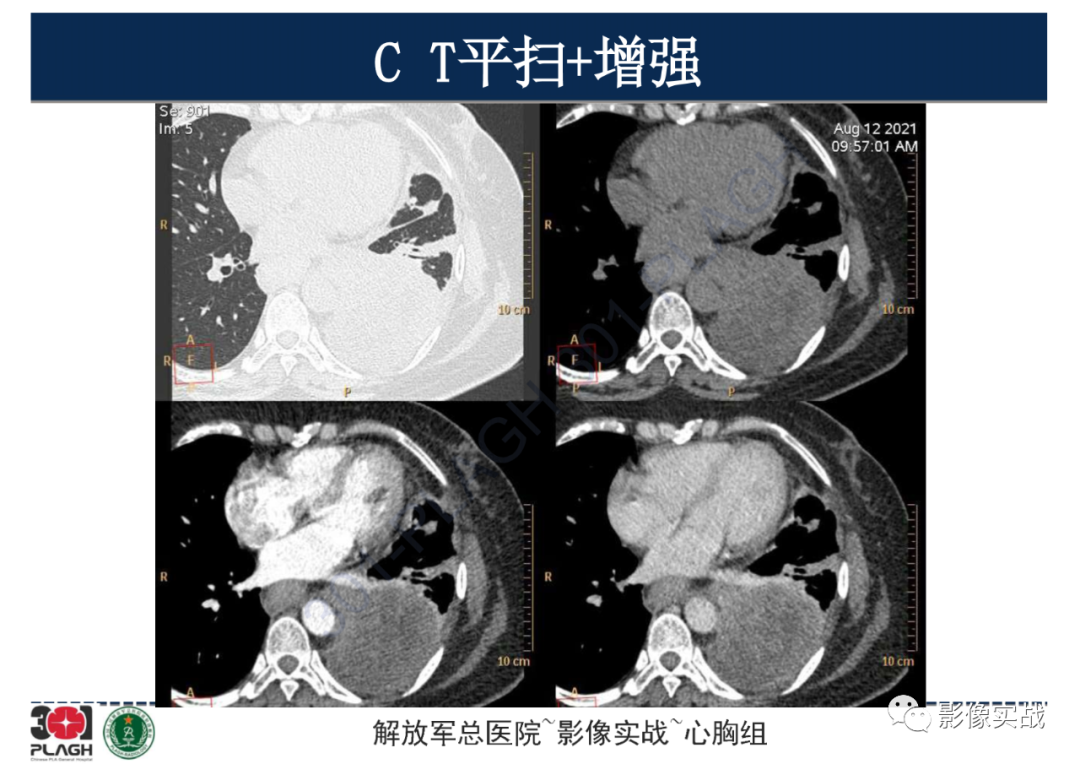 影像PPT - 【病例】左侧胸腔孤立性纤维肿瘤1例CT-7