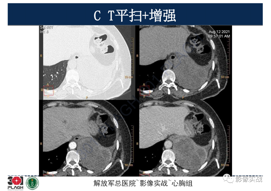 影像PPT - 【病例】左侧胸腔孤立性纤维肿瘤1例CT-10