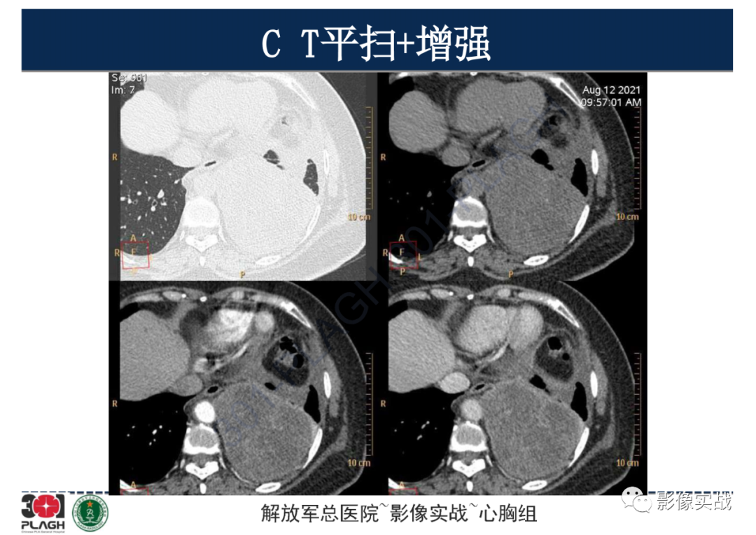 影像PPT - 【病例】左侧胸腔孤立性纤维肿瘤1例CT-9