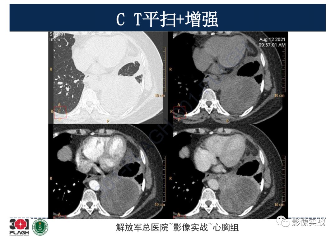 影像PPT - 【病例】左侧胸腔孤立性纤维肿瘤1例CT-8
