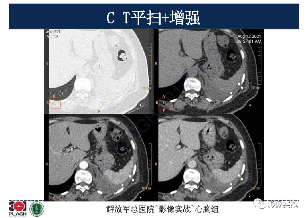 影像PPT - 【病例】左侧胸腔孤立性纤维肿瘤1例CT-11